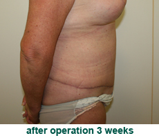 plastic-surgery-tummy-tuck